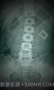 X射线扫描器胃截图4 X射线扫描器胃截图4